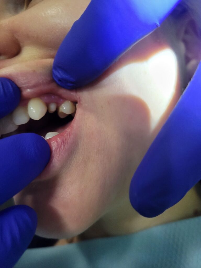 Циркониевая вкладка